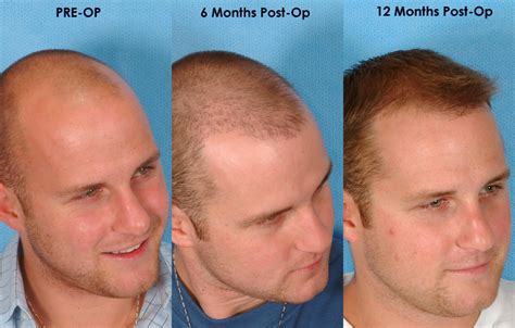 best hair transplant in dubai.